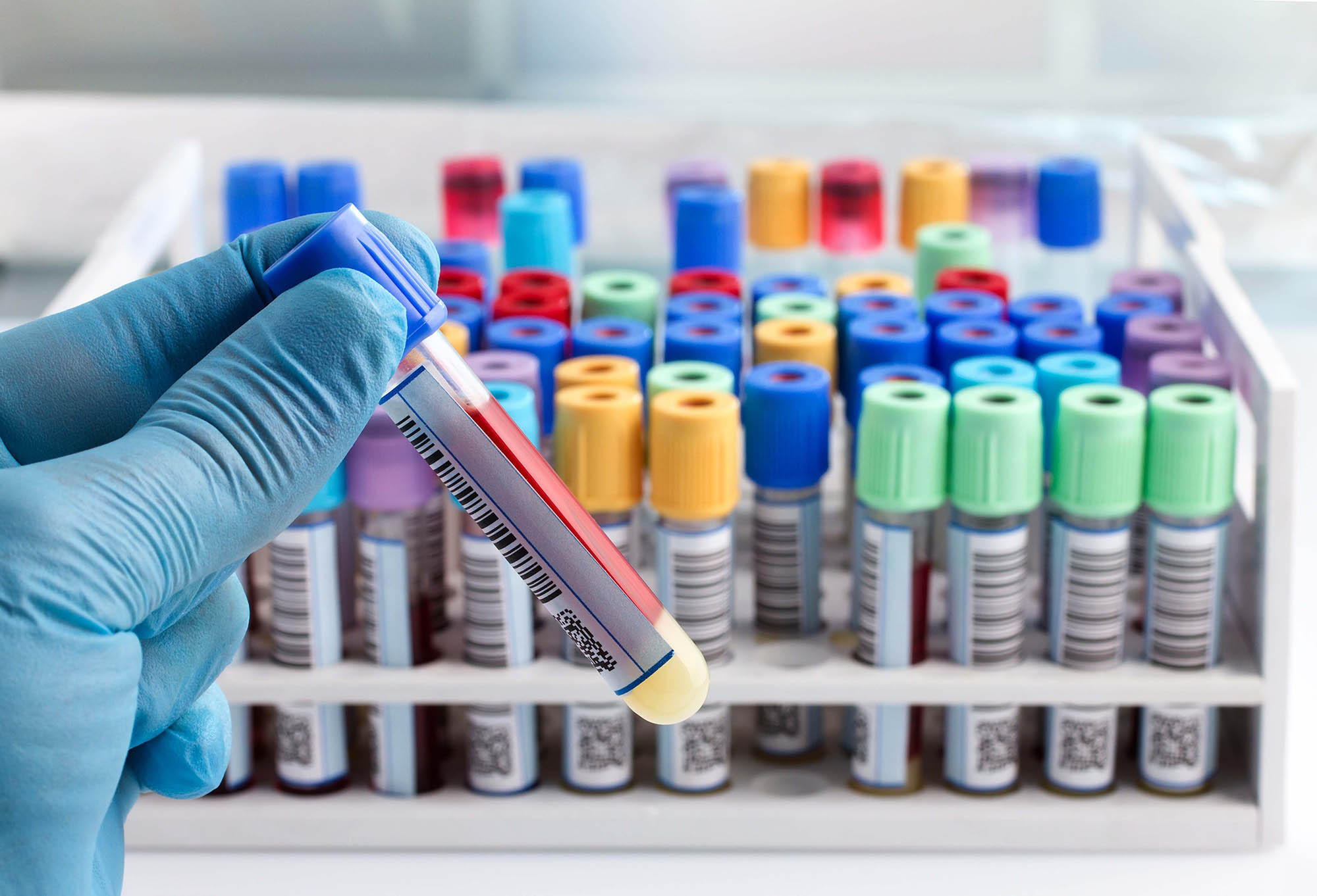 hand of a lab technician holding blood tube test and background a rack of color tubes with blood samples other patients / laboratory technician holding a blood tube test with code bar
